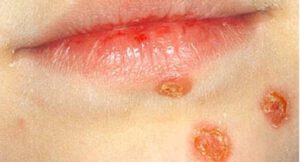 Impetigo